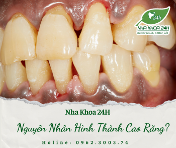 NGUYÊN NHÂN HÌNH THÀNH CAO RĂNG