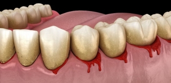 NGUYÊN NHÂN BỆNH SÂU RĂNG