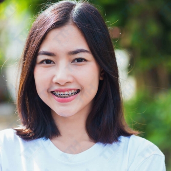 NIỀNG RĂNG MẮC CÀI LÀ GÌ?