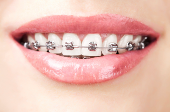 TẠI SAO NÊN LỰA CHỌN PHƯƠNG PHÁP NIỀNG RĂNG TRONG SUỐT INVISALIGN?