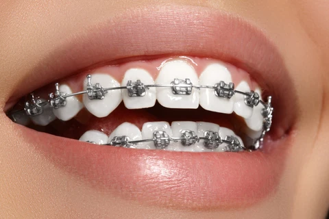 NIỀNG RĂNG INVISALIGN LÀ GÌ?