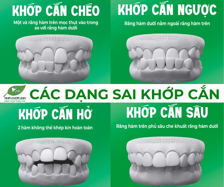 CÁC DẠNG SAI KHỚP CẮN BA MẸ KHÔNG THỂ BỎ QUA?