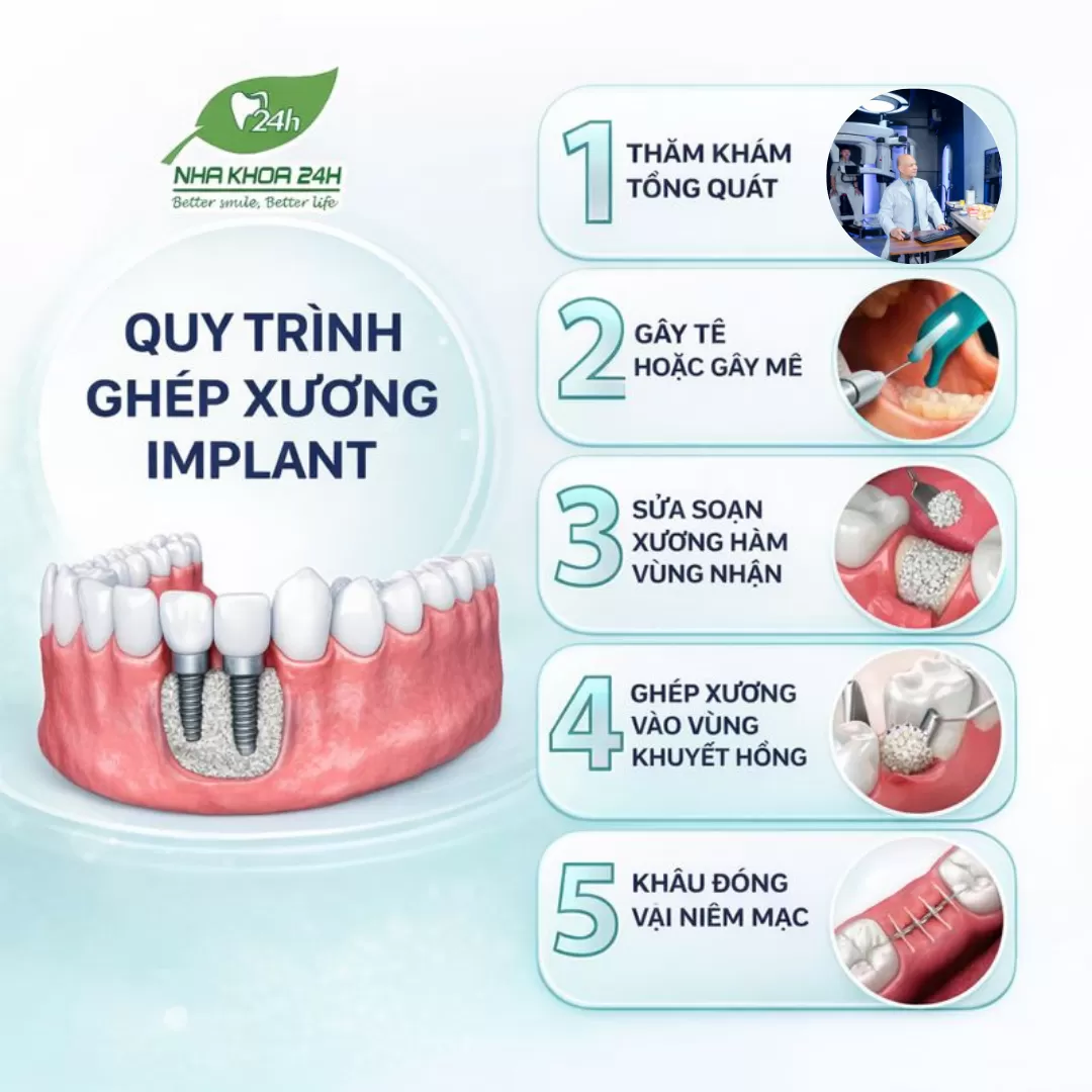 Quy trình ghép xương Implant an toàn – hiệu quả tại Nha khoa 24H
